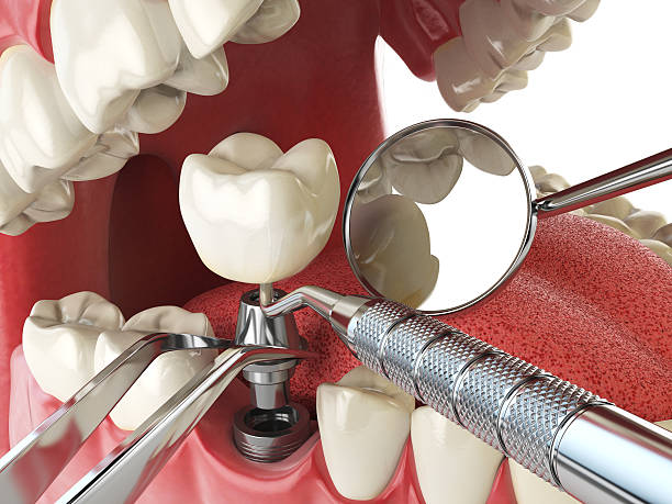 Best Emergency Denture Repair in Elwood, NY